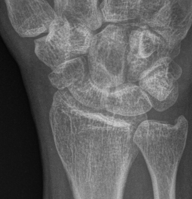 Scaphoid Nonunion